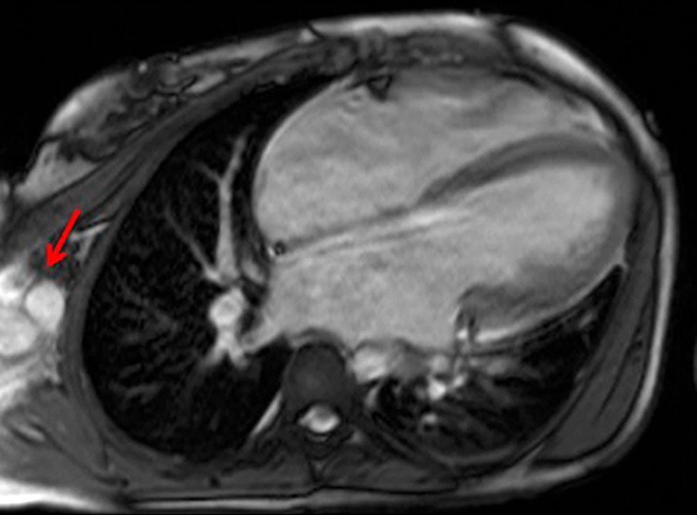 MRI – Arteriovenous malformation
