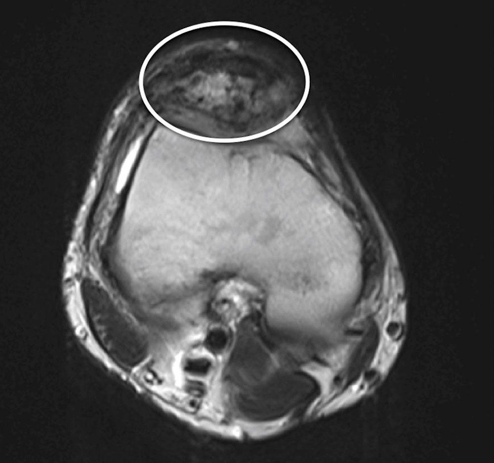 MRI at the level of the patella