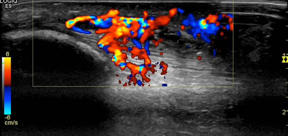Color-coded duplex sonography – hyperperfused vessels