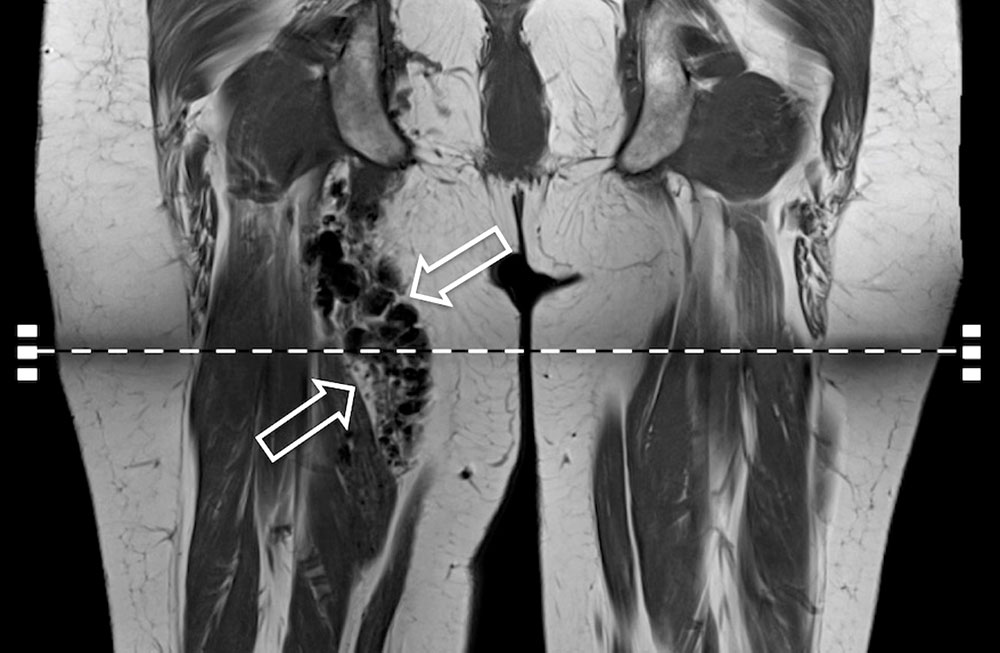 MRI of an AVM nidus