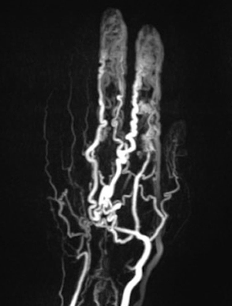 MR angiography of the hand
