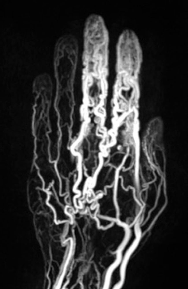 MR angiography of the hand 