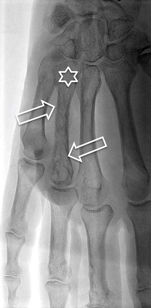 X-ray image of an AVM