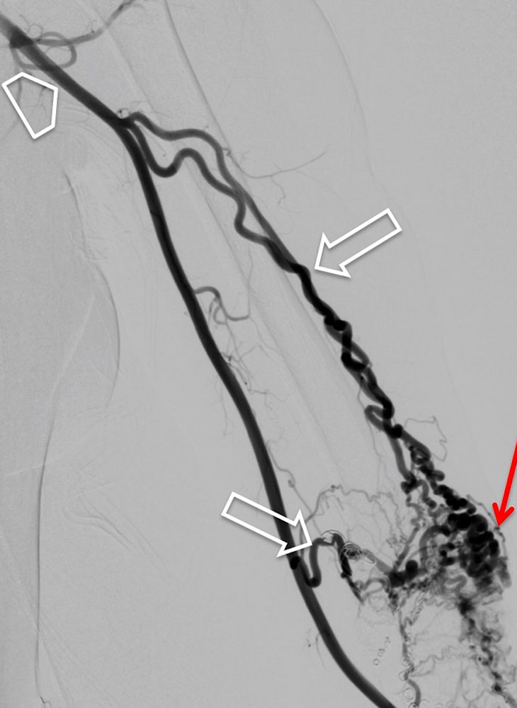 DSA of the left upper arm