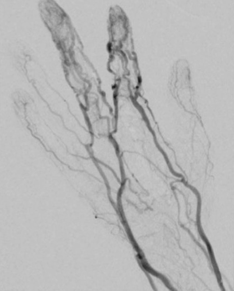 DSA of the hand shows the clearly dilated drainage veins