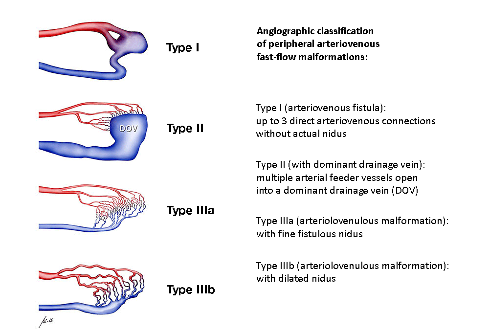 Angiographic classification of AVM