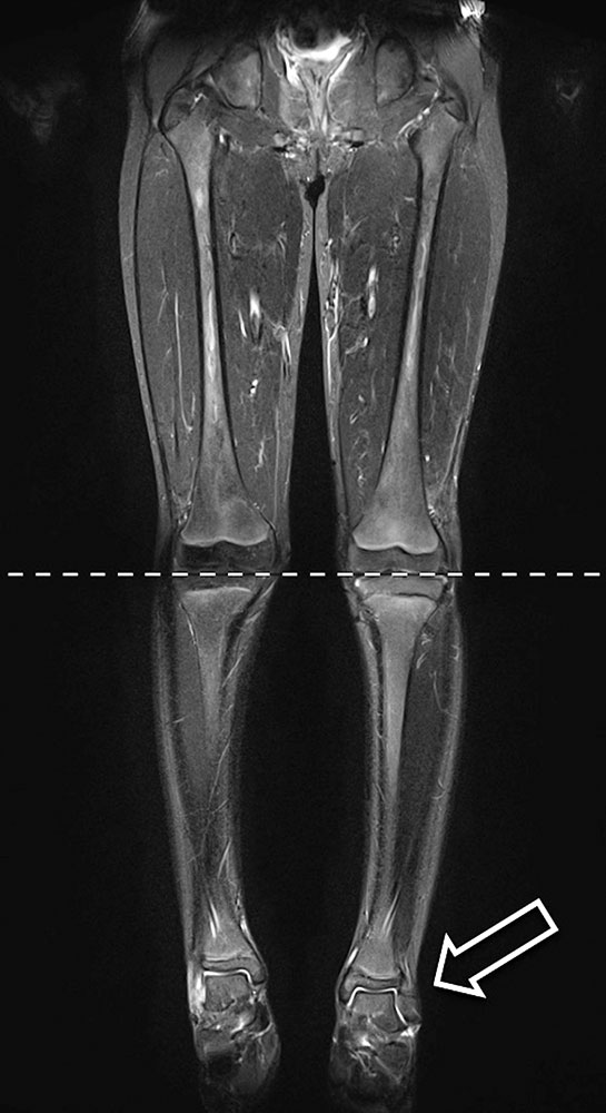 MRI – Leg length discrepancy