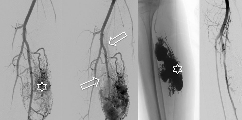 DSA – Arteriovenous malformation