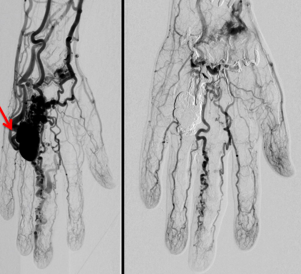 DSA – Venous aneurysm