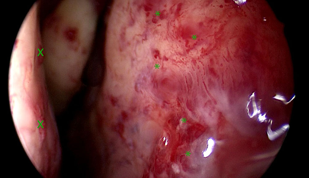 Endoscopic image in a case of HHT