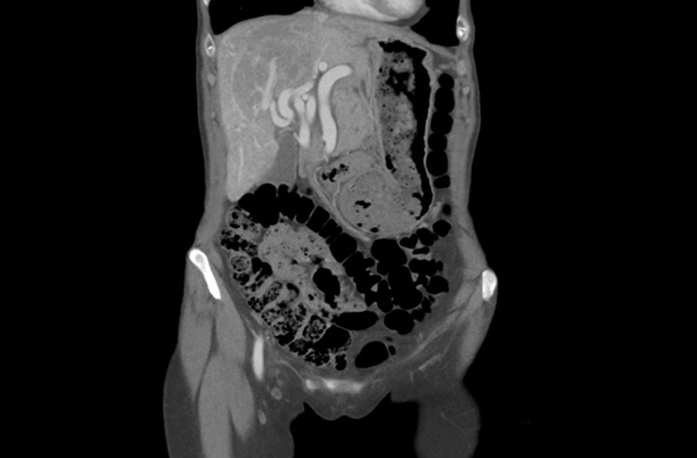 Massively dilated hepatic artery