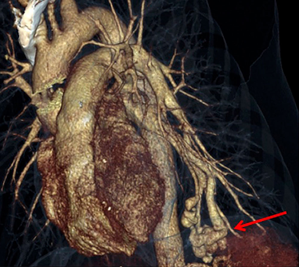 3D computed tomography of the lung