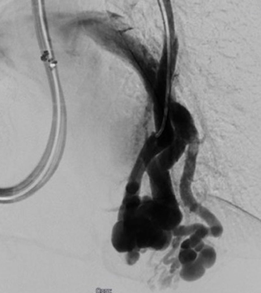 Digital subtraction angiography of pulmonary arteriovenous malformation