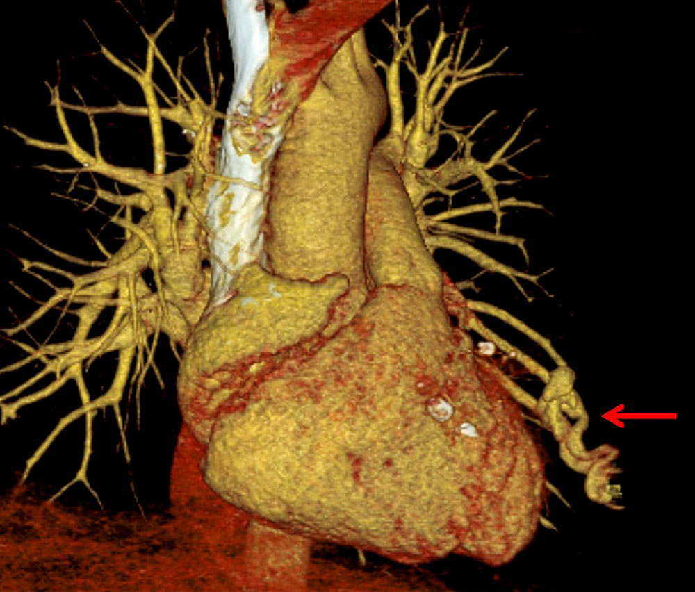 3D computed tomography of the lung