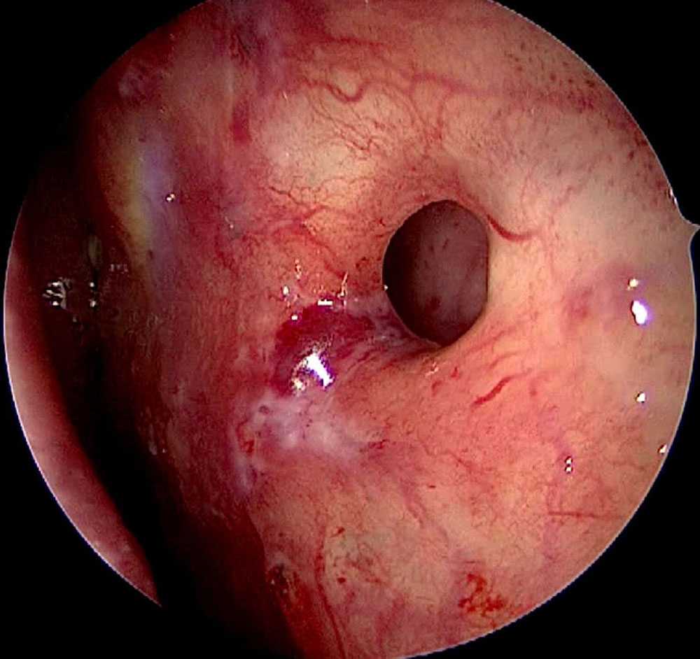 Defect of the nasal septum, still smal