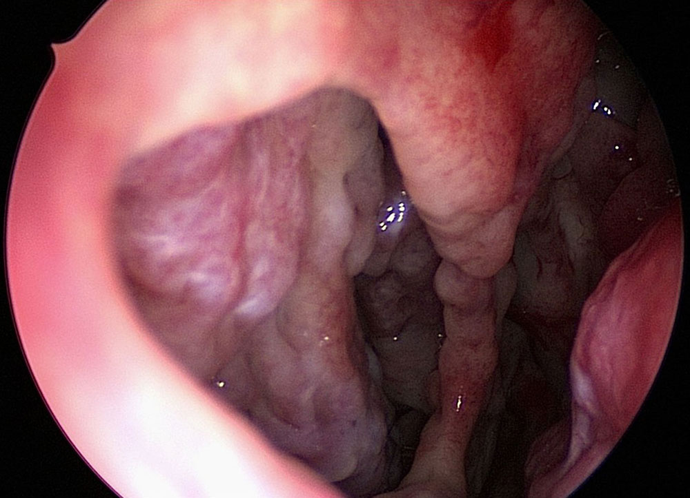 Defect of the nasal septum, already large