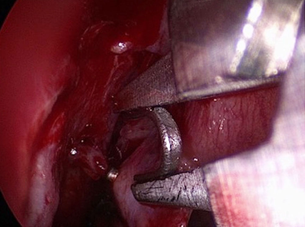 Clipping of the sphenopalatine artery