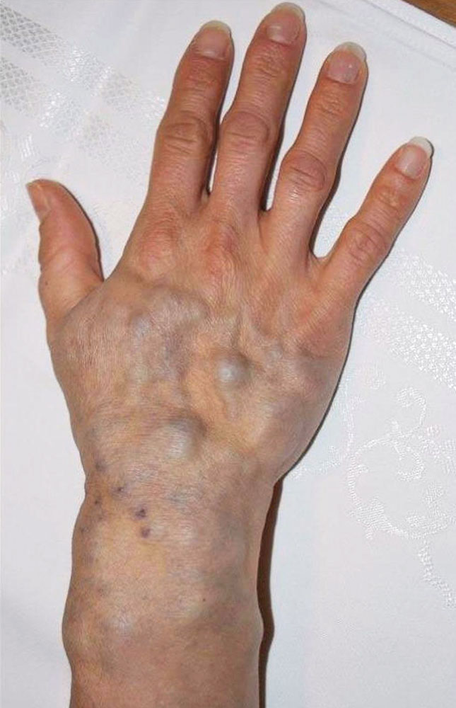 Venous malformation of the hand