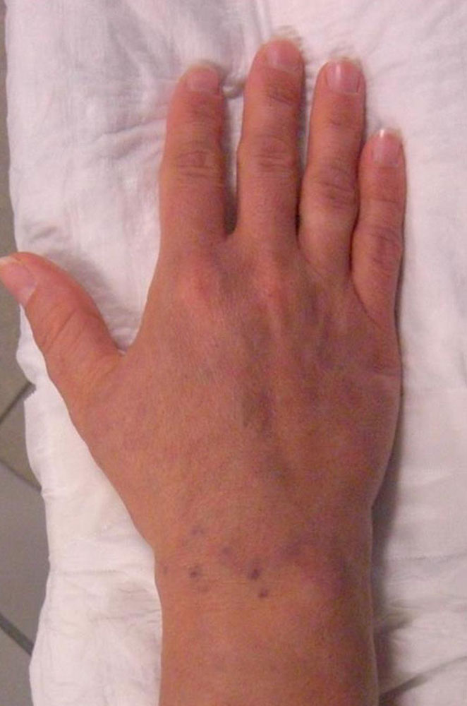 Venous malformation of the hand
