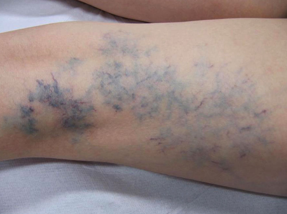 Venous malformation on the right leg