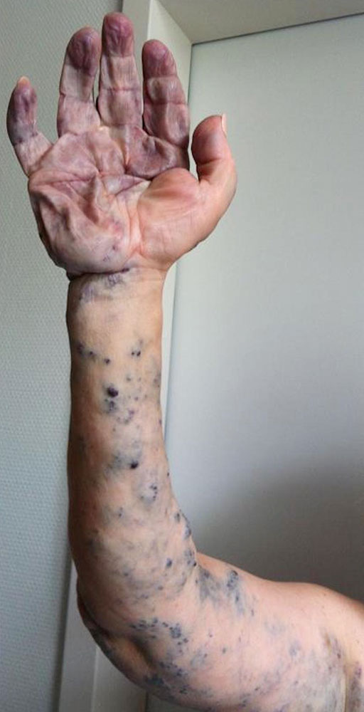 Sponge-like venous malformation of the hand and the entire left arm
