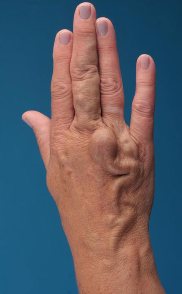 Venous aneurysm on the back of the hand