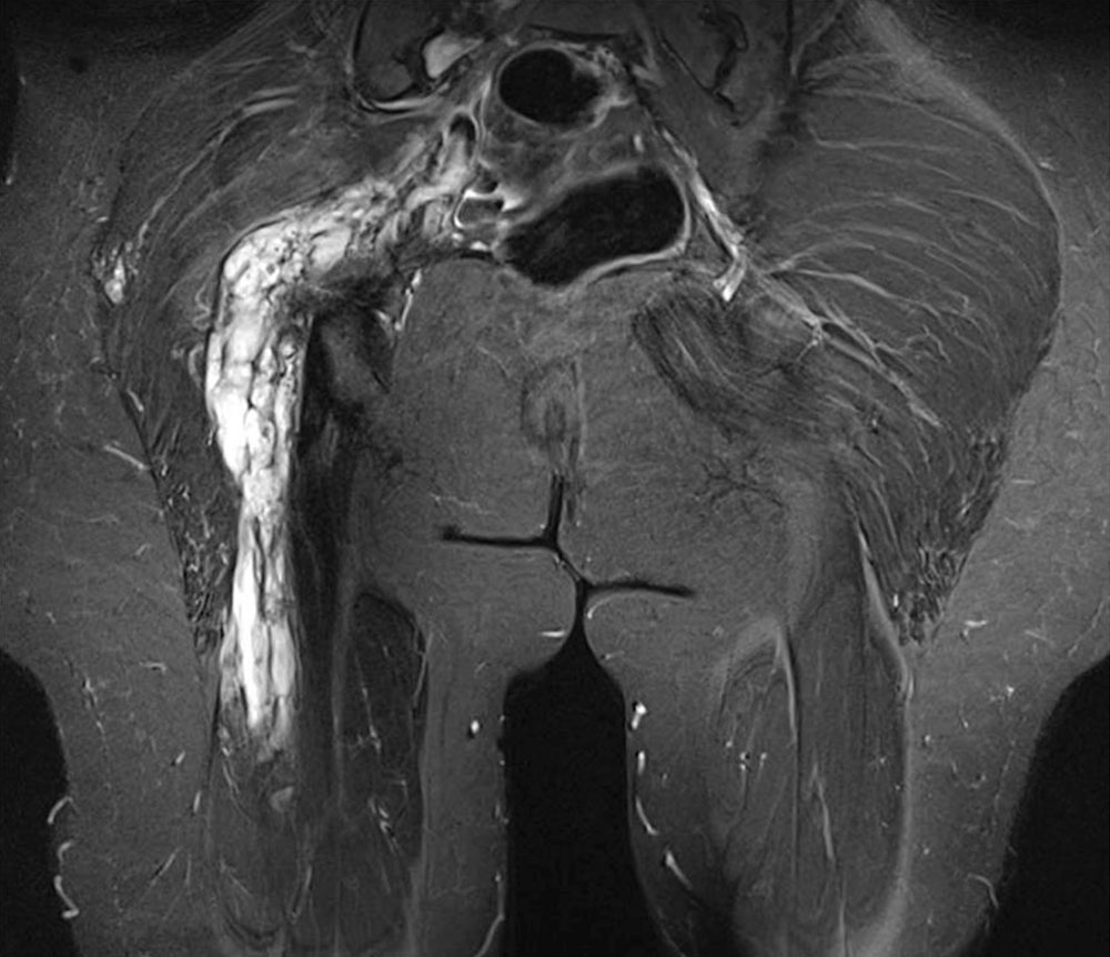 MRI – Venous malformation