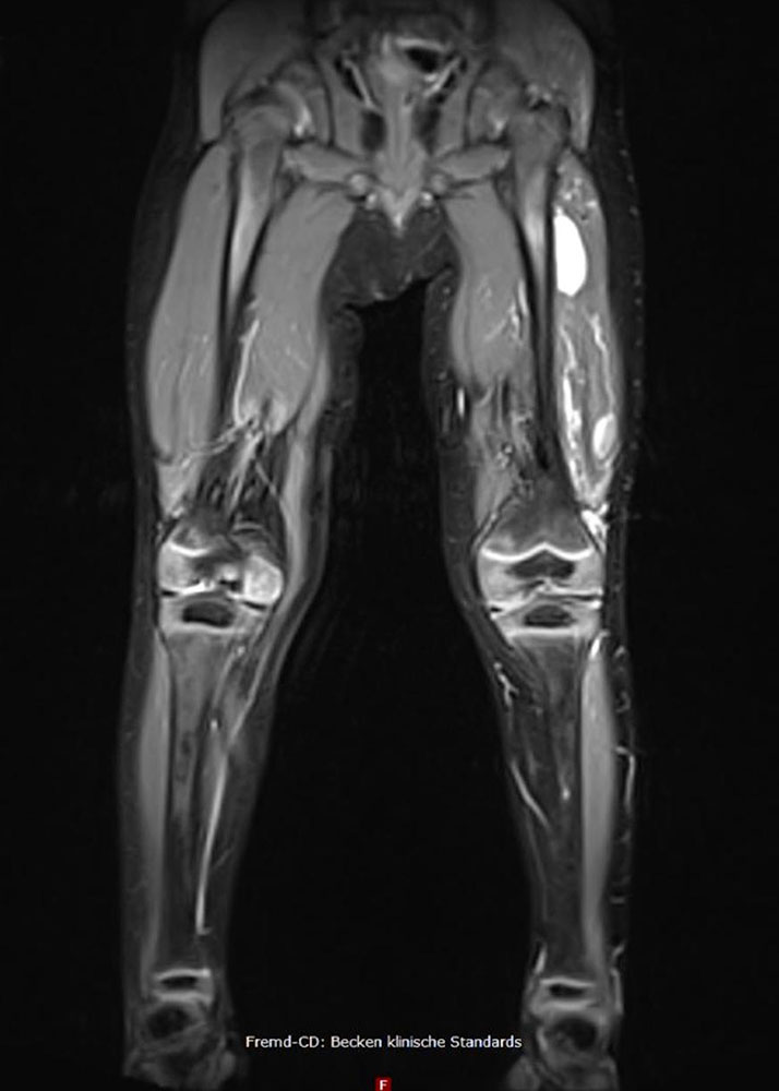 MRI in a 5-year-old boy with a venous malformation of the left thigh