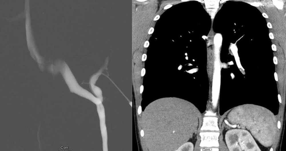 CT – Large communicating vein from a marginal vein