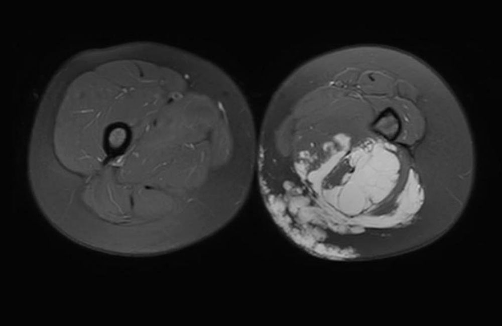 MRI – Communicating vein from a marginal vein