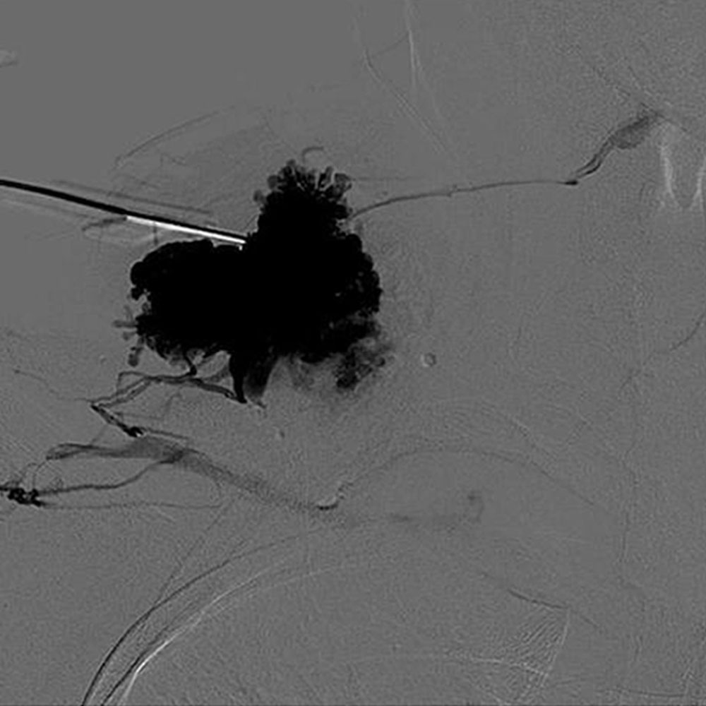 DSA of a circumscribed venous malformation on the right shoulder