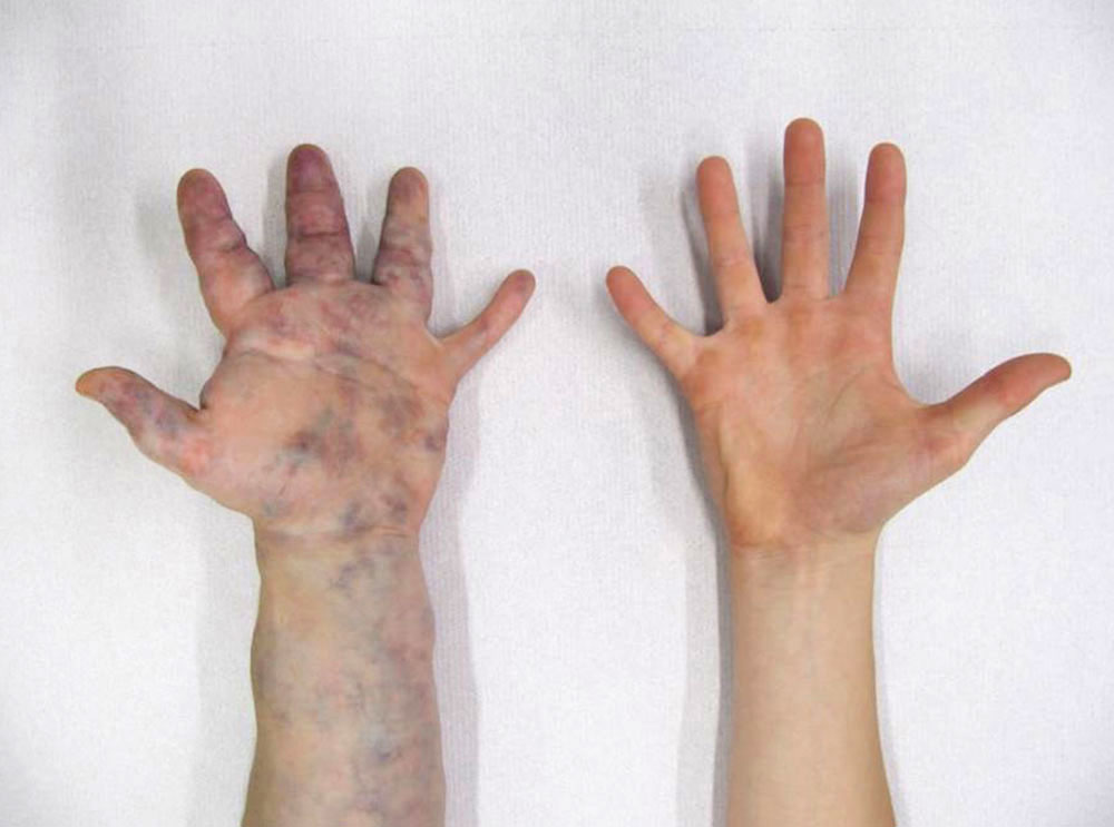 Extensive venous malformation on the left hand