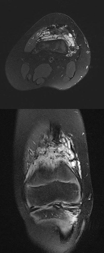 MRI of the left knee