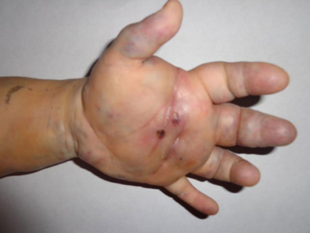 Hand with an extensive venous malformation