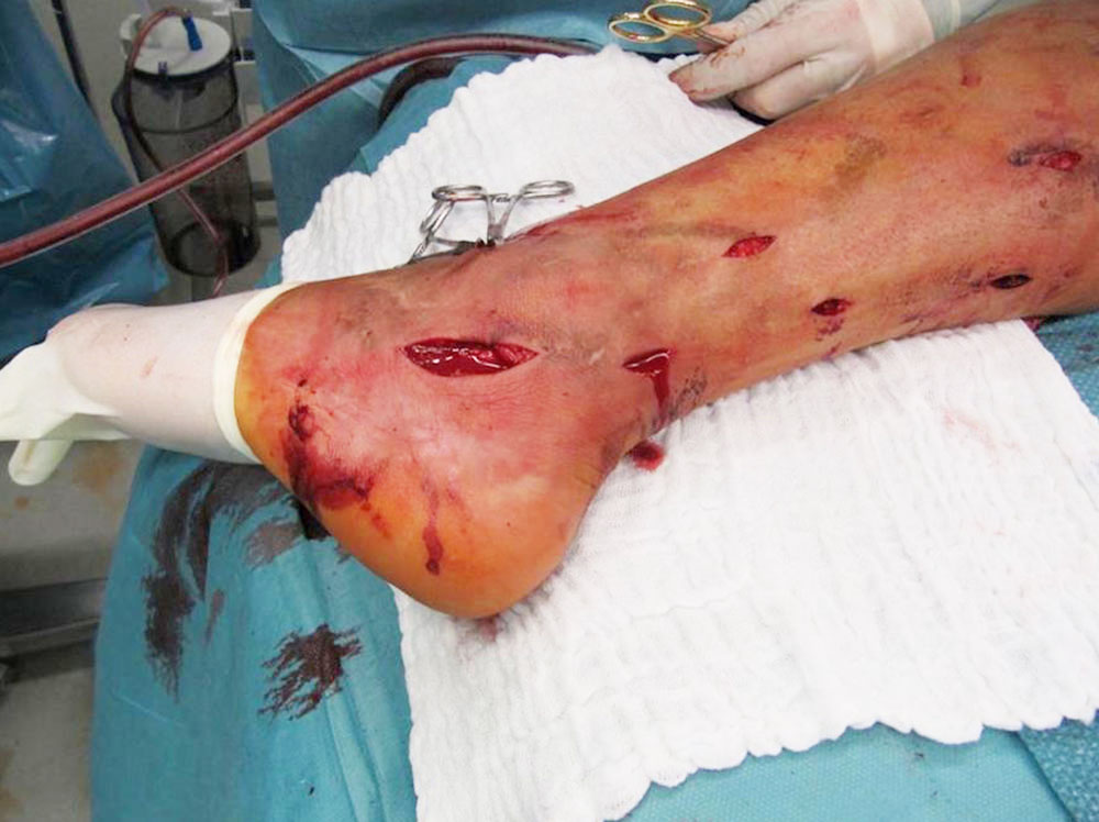 Extensive venous malformation