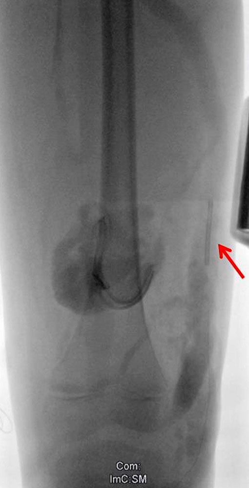 Radiofrequency ablation of a marginal vein