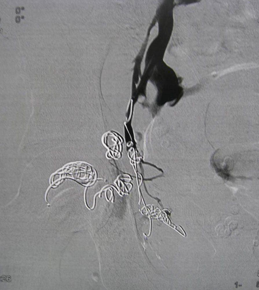 Vein after coiling