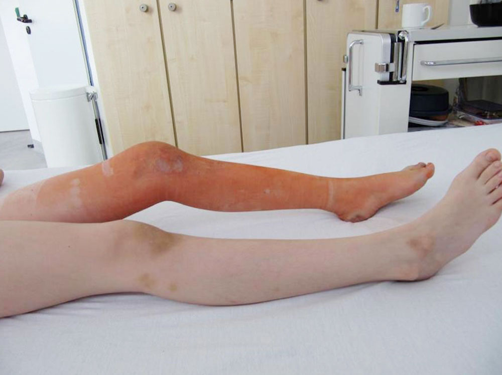 Venous malformation affecting the left knee and foot