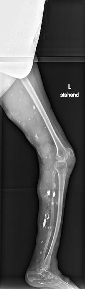 X-ray image of the left leg
