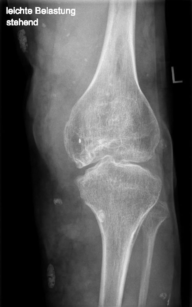 X-ray image of the left knee