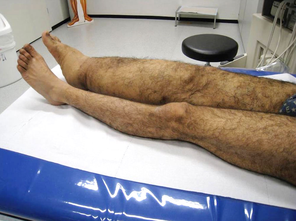 Klippel-Trénaunay syndrome of the right side of the body