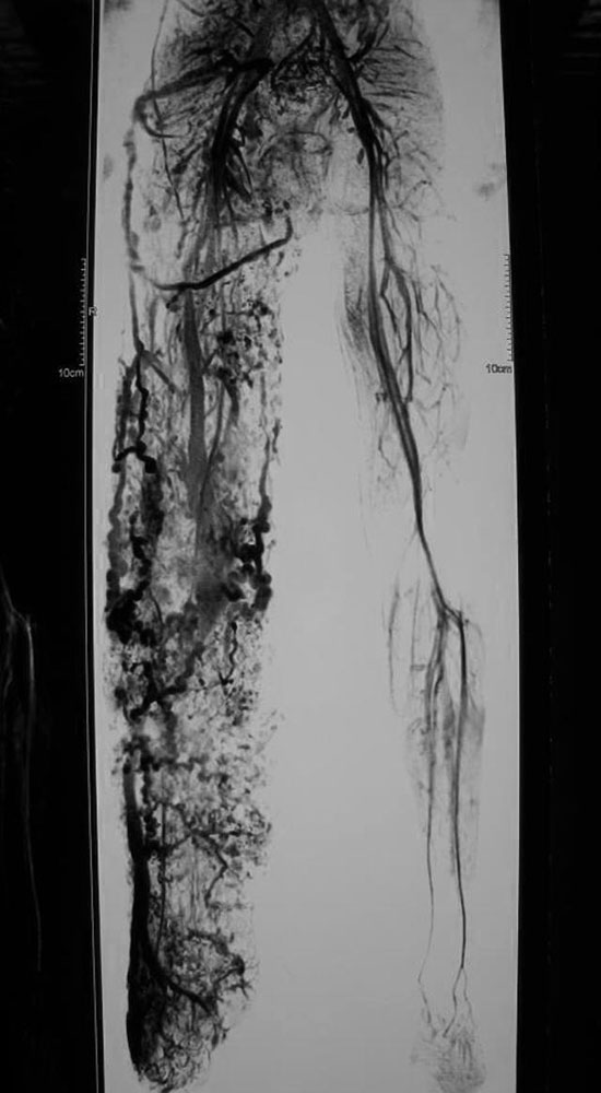 MR angiography in Klippel-Trénaunay syndrome