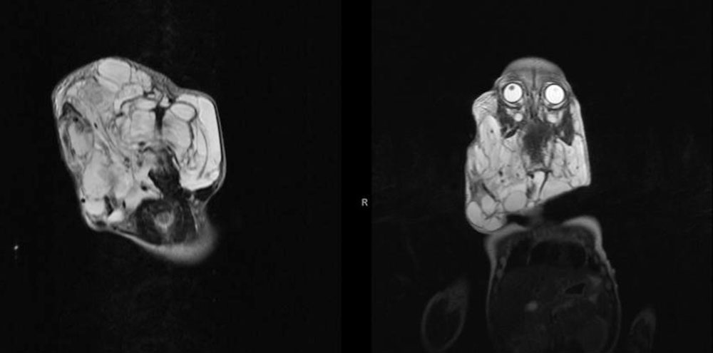 Lymphatic malformation of the head and neck region