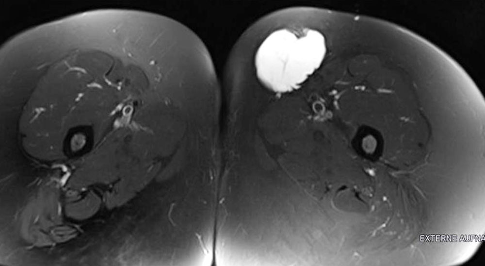 Macrocystic lymphatic malformation of the left thigh