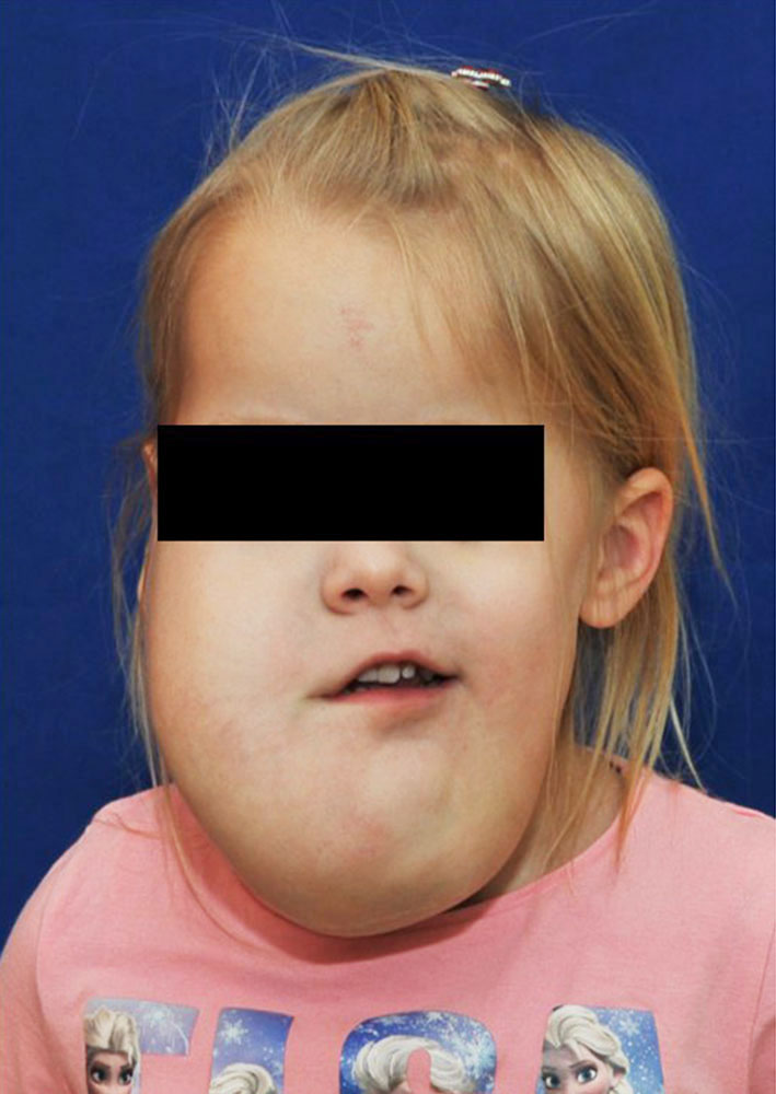 Cystic lymphatic malformation of the head and neck
