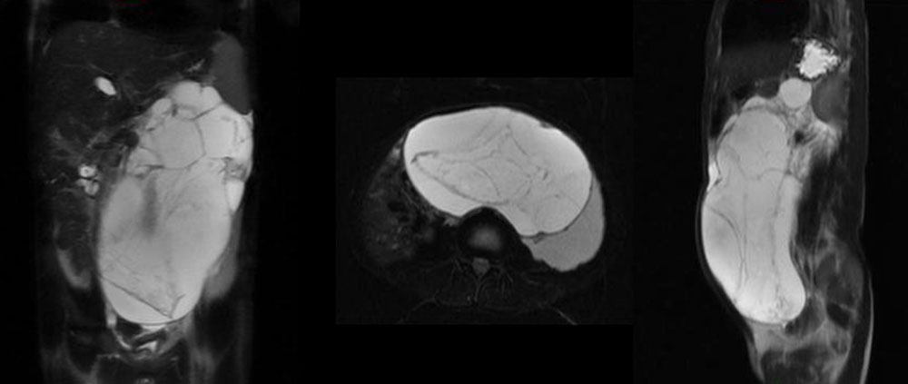MRI – Retroperitoneal lymphatic malformation