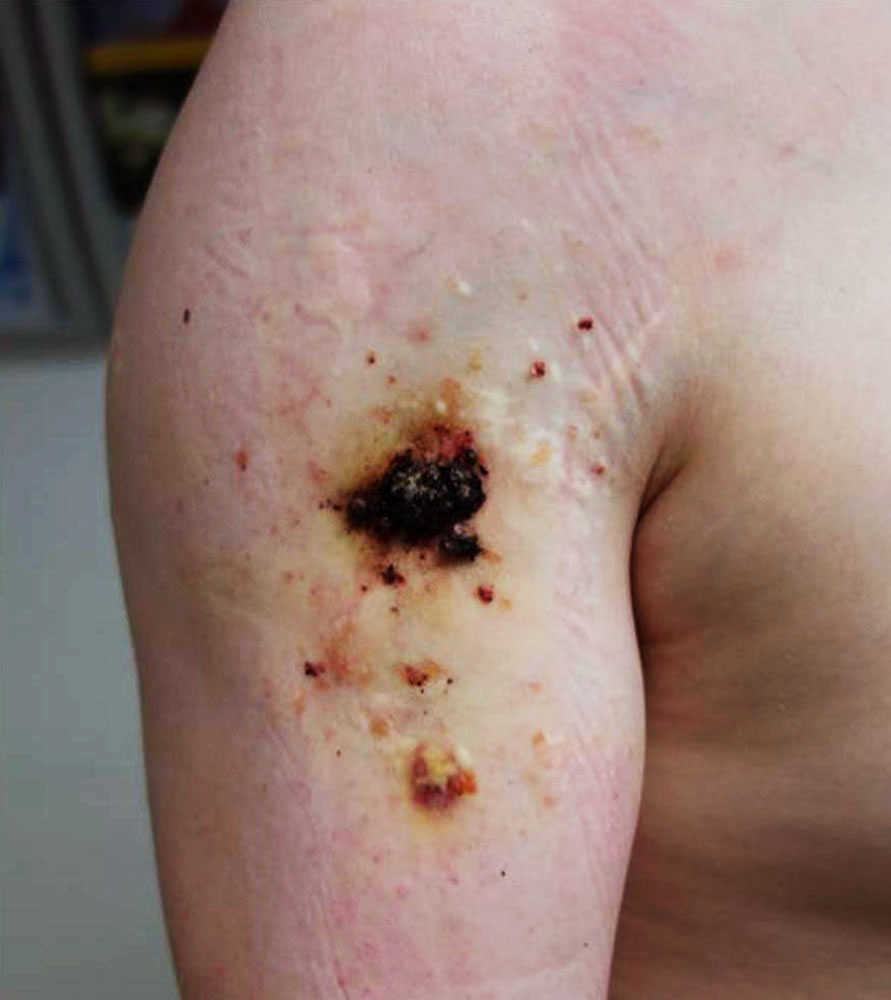 Lymphatic malformation with partially hemorrhaged vesicles in the skin