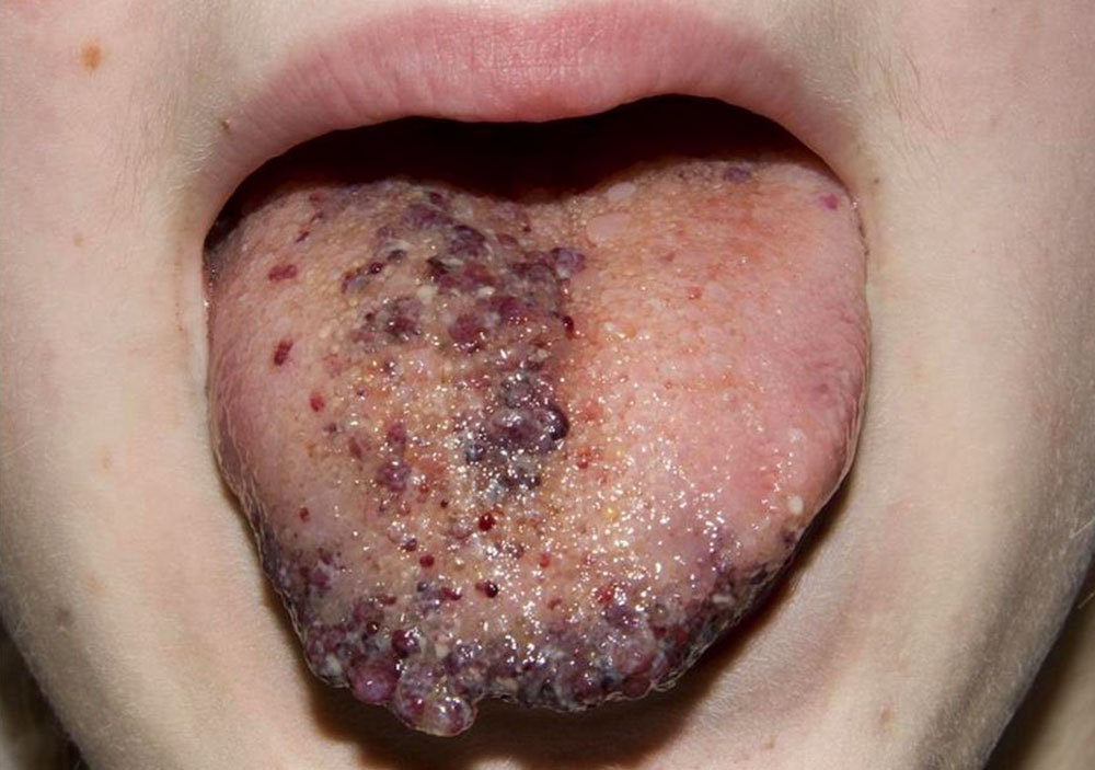 Microcystic lymphatic malformation of the tongue