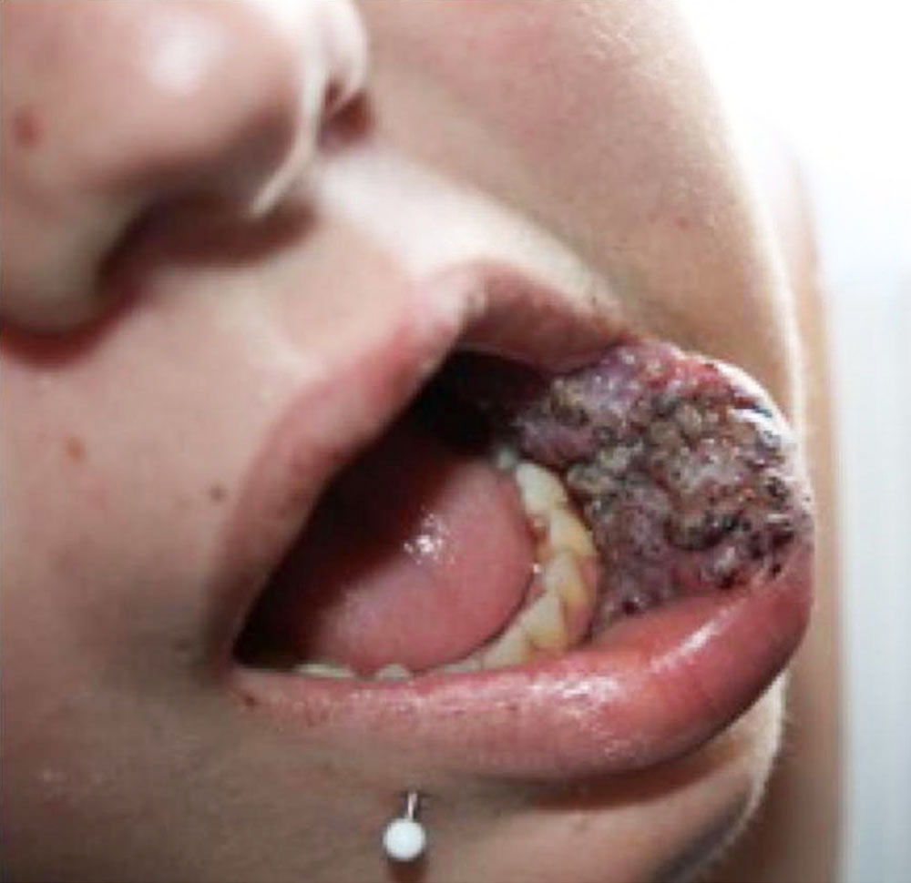 Lymphatic malformation on the mucosa