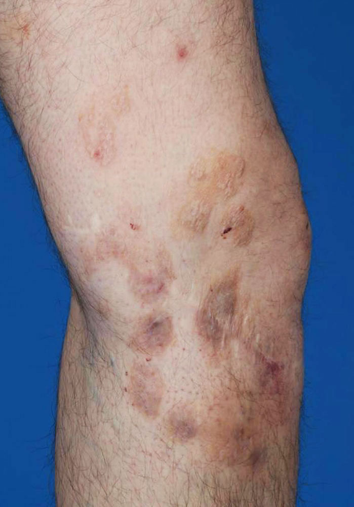 Multiple skin lesions due to a lymphatic malformation extending